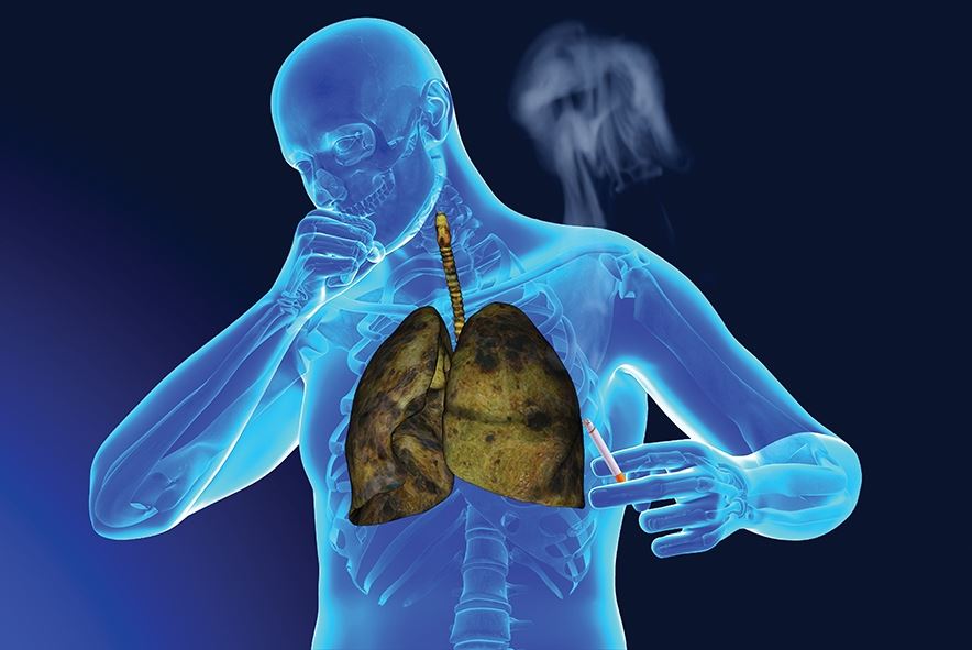 2040 yılında 29,5 milyon akciğer kanseri vakası çıkabilir